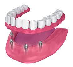 Dentures Image 2