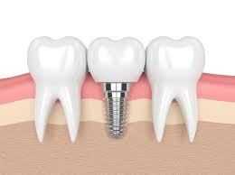Dental Implants Image 1
