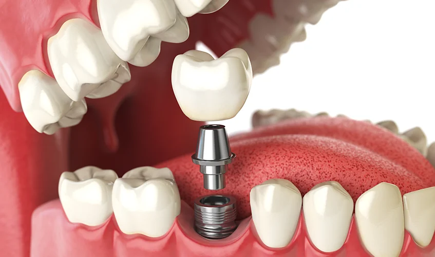 Dental Implants Image 2